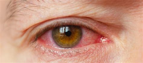 It is usually injection and prominence of the superficial blood vessels of the conjunctiva. Signs That Someone Is Intoxicated By Marijuana I Growing ...