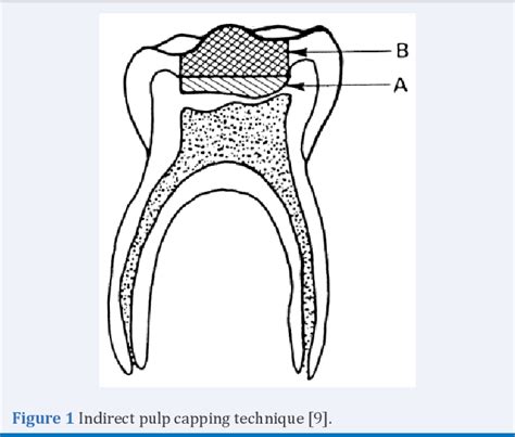 Figure 1 From Indirect And Direct Pulp Capping Reactionary Vs