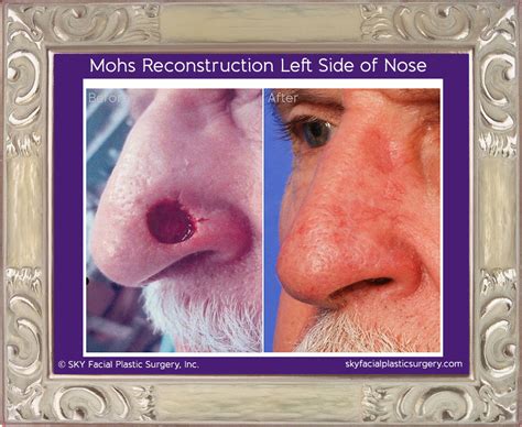 Mohs Reconstruction In San Diego After Skin Cancer — Sky Facial Plastic
