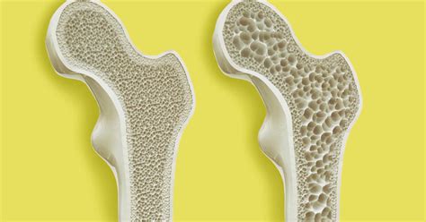 Osteoporosis Causas S Ntomas Y Tratamiento