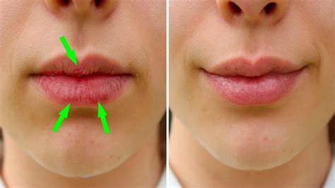 Here S How To Heal Your Dry Chapped Lips Naturally Youtube