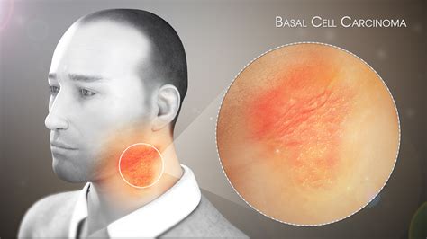 Basal Cell Carcinoma Shown Explained Using A D Medical Animation My