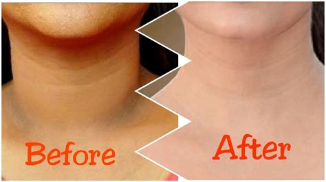 How To Get Rid Of Dark Neck In 15 Minutes Fast And Quickly Dark