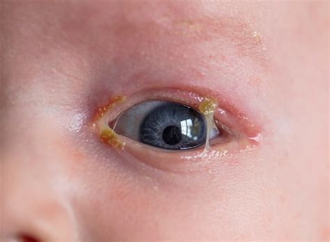 Approach To Conjunctivitis In Newborns The Bmj