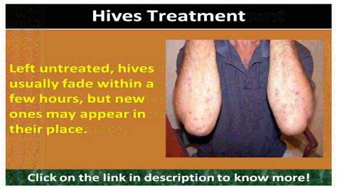2 Hives Urticaria Treatment Youtube