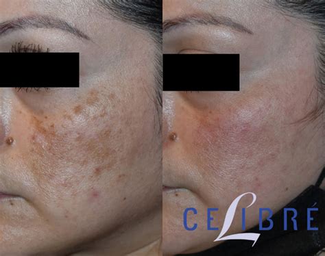 Melasma Before And After Pictures