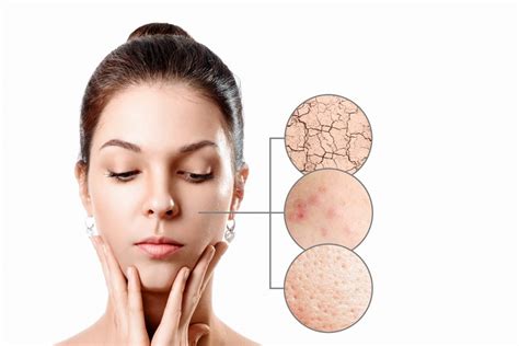 Young Woman With Acne Dry Skin Black Dots Skin In Zoom Circle Skin