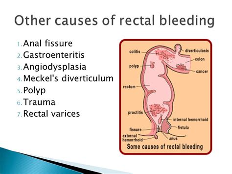 Stop Rectal Bleeding Causes Treatment Symptoms And Remedies