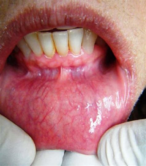 Mild Erythema Of The Lower Labial Mucosa With No Other Clinically