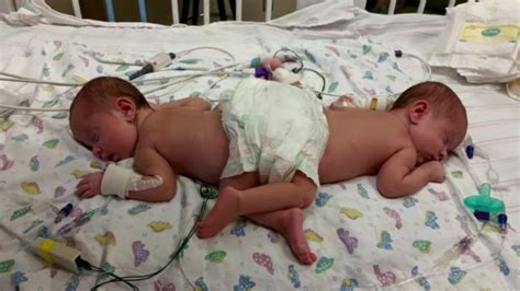 Conjoined Sisters Undergo Rare Separation Surgery Cnn