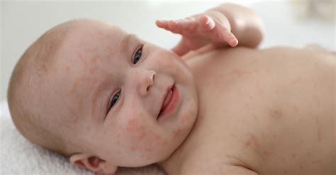 Food Allergies In Babies Elite Medical Center