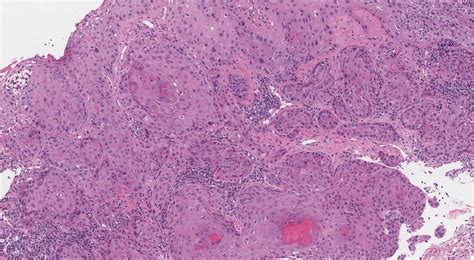 Squamous Cell Carcinoma Of The Anal Canal Mypathologyreportca