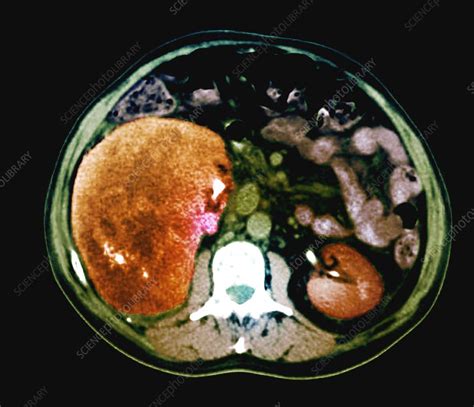 Kidney Cancer Ct Scan Stock Image C0525644 Science Photo Library