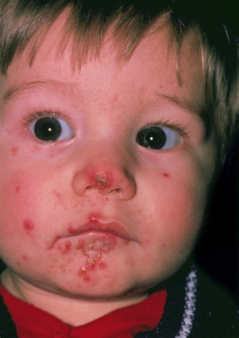 Impetigo And Ecthyma Dermatologic Disorders Msd Manual Professional