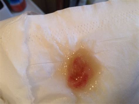 Tmi Clump Of Bloody Mucous After Blowing Nose Glow Community My Xxx