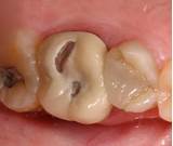 Pictures of Gum Line Cavity Treatment