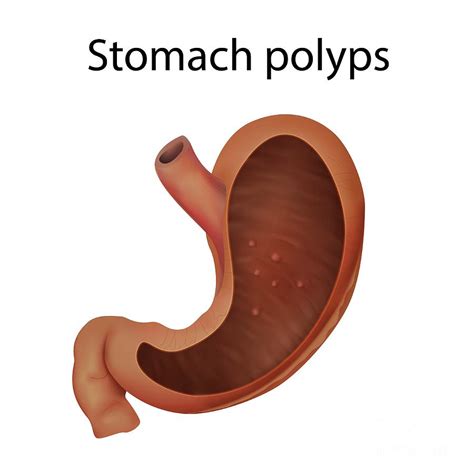 Stomach Polyps Photograph By Veronika Zakharovascience Photo Library
