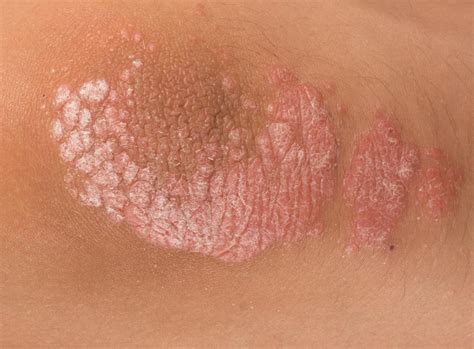 Psoriasis What Are The Signs And Symptoms