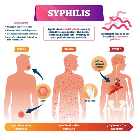 Secondary Syphilis The Great Imitator And Pretentious Rash Dr Ben Medical Mens Health