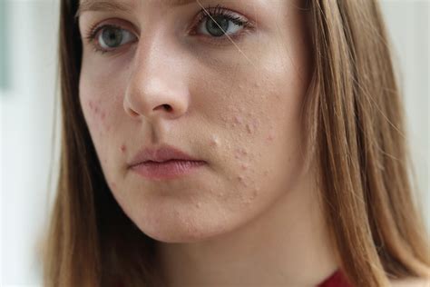 #face#acne#remove #dark spot from face#naturally#get rid of acne#freckles#bruised face#dirty face#wrinkled face#lots of acne#acne#small acne#dry skin#oily. Acne | What is Acne | Causes and Types | LloydsPharmacy
