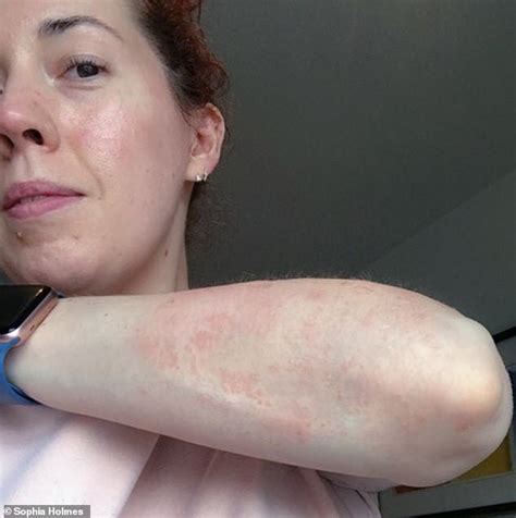 Psoriasis Sufferer Claims Cream Made From Plant Root Has Helped Skin Hot Lifestyle News