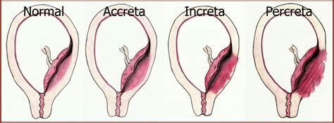 placenta previa — taming the sru