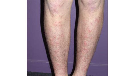 Tiny Red Spots On Legs Not Itchy Jameslemingthon Blog