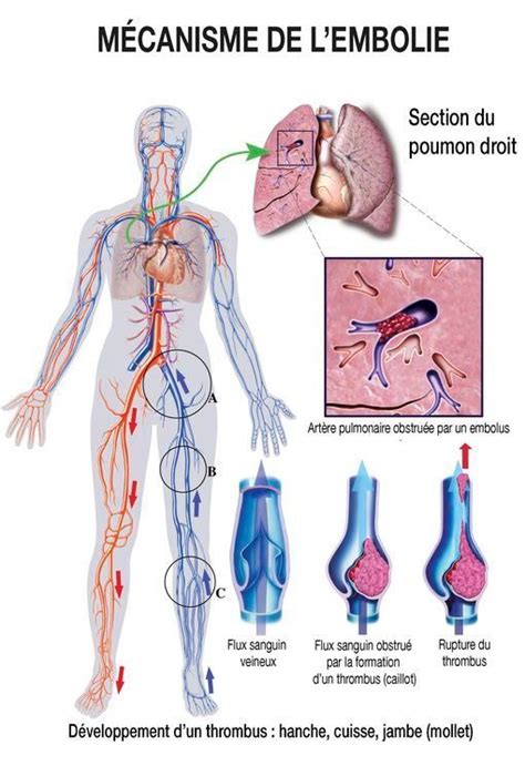 Téměř všechny plicní embolii jsou výsledkem trombózy u dolních končetin nebo pánve žil (hluboká žilní trombóza gw). Jambes lourdes - Thrombose, phlébite, embolie : quels sont vos risques ? - Doctissimo