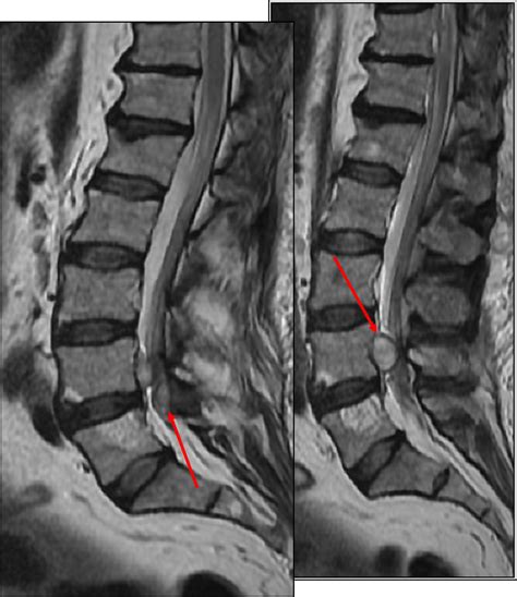 Lumbar Spinal Synovial Cyst Image