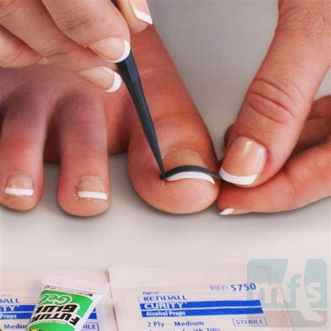 How To Cure An Ingrown Toenail Infection