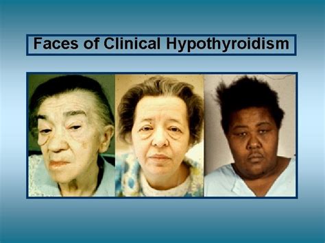 Hypothyroidism Signs And Symptoms Classic Teaching V V