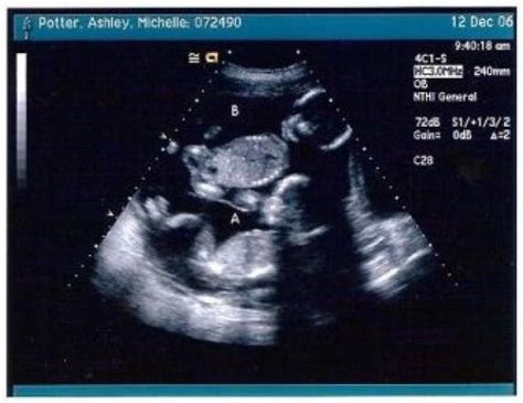 How An Ultrasound Can Reveal If You Are Carrying A Hidden Twin Twins
