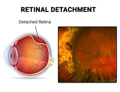 Retinal Detachment Nyc Vitreous Retina Macula Consultants Of New York