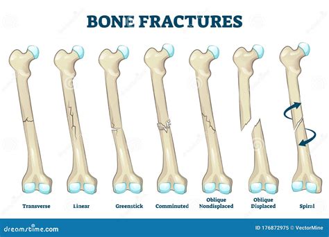 A Set Of Bone Fractures Vector Illustration 119238752
