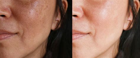 Lumecca Ipl Photofacial Skin Rejuvenation Hush La Medspa