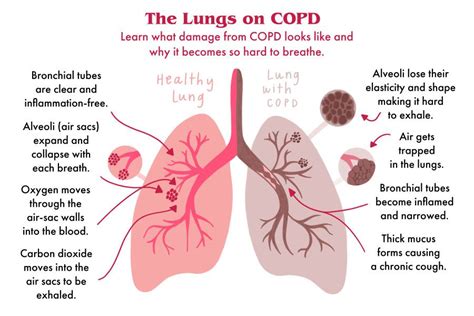 This Is Your Lungs On Copd Copd Copd Awareness Copd Symptoms