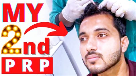Going For My Second Prp After Hair Transplant Prp Treatment Results