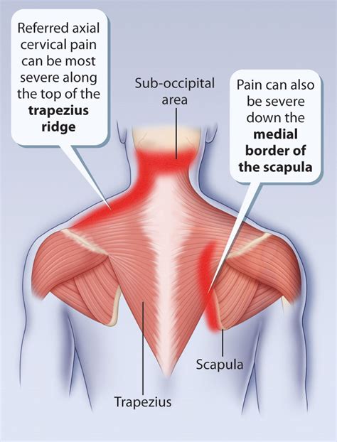 This muscle extends across the neck, shoulder, and back. Got Shoulder Pain? Don't be surprised if your massage ...