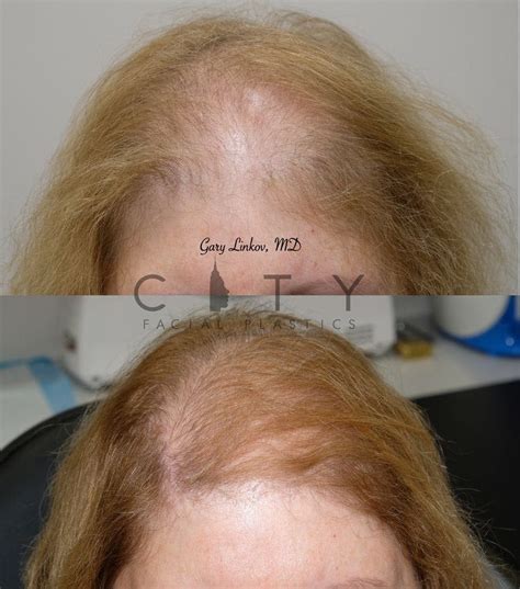 Nyc Alopecia Treatment New York Therapy For Hair Loss Ues