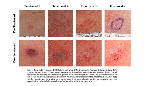 Stages Of Basal Cell Carcinoma Skin Cancer Types Of M