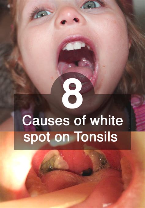 White Spots On Tonsils How To Fight With The Illness White Spots On