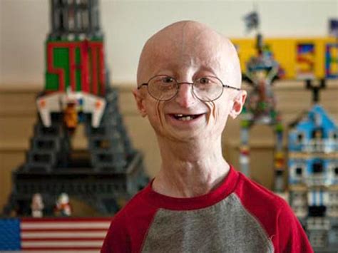 La Progeria O Vejez Prematura Medicusmeo