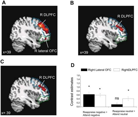A Activation In The Right Dorsolateral Prefrontal Cortex Dlpfc And