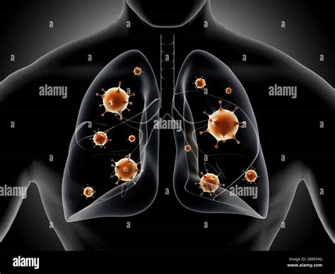 Medical Illustration Showing Pneumonia In The Human Lungs Stock Photo