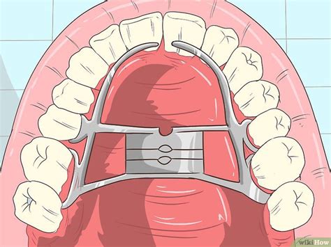 Here's how to straighten teeth without braces, all depending on your condition or what you'd like to see change. Straighten Your Teeth Without Braces | Teeth straightening ...