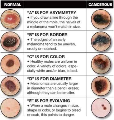 Mammograms are one way of checking for cancercredit: Your Yearly Skin Check: Why You Should Book Your ...