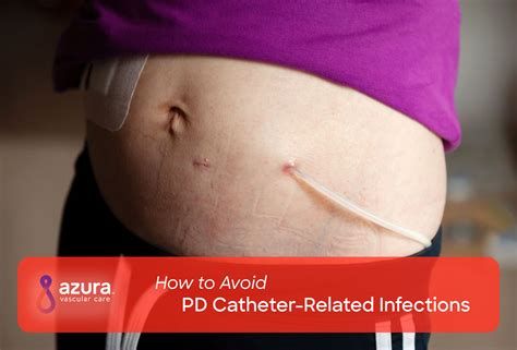 How To Avoid Pd Catheter Related Infections Azura Vascular Care