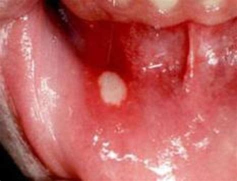 Then, it is called oropharyngeal. Canker Sores: What to do | hubpages