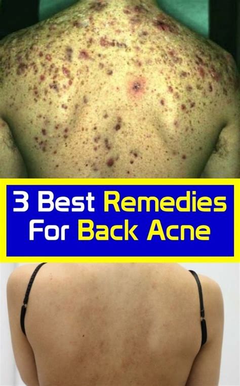 3 Best Back Acne Remedials In 2020 Best Acne Remedies Back Acne
