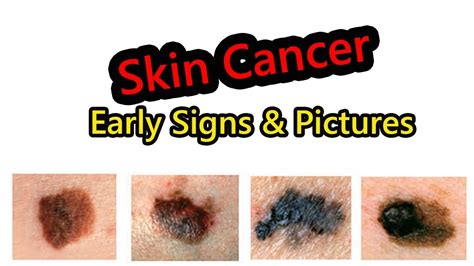 Early Signs Of Skin Cancer Melanoma You Must Know Youtube